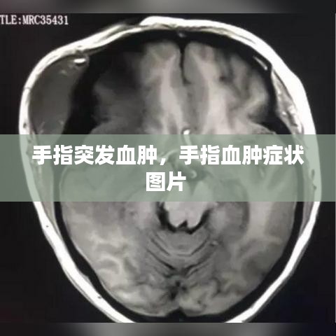 手指突发血肿，手指血肿症状图片 