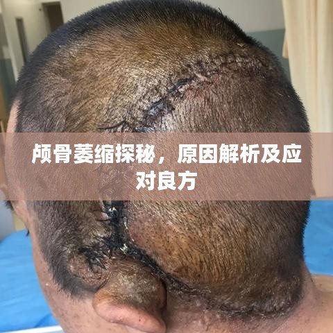 颅骨萎缩探秘，原因解析及应对良方